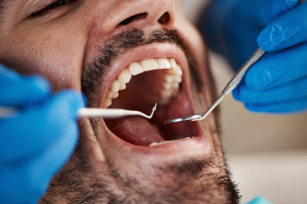 Best Knocked-Out Tooth (Avulsed Tooth) Treatment in Darnestown, MD