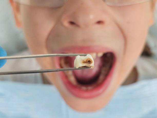 Best Broken or Chipped Tooth Repair in Darnestown, MD